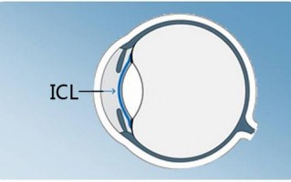1600度怎么美薄镜片，1600度美薄镜片可以做到多薄