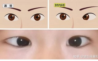 矫正视力低是什么原因，矫正视力低是什么原因造成的